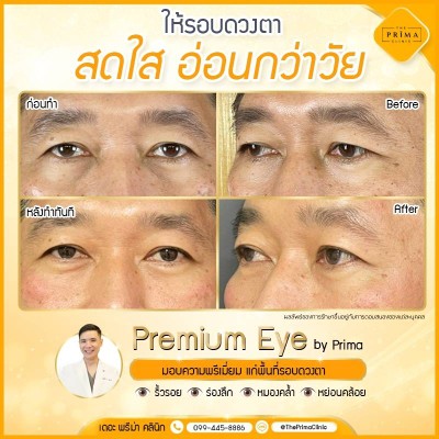 รีวิว The Prima Clinic Si Racha เดอะ พรีม่า คลินิก ศรีราชา ศรีราชา -  Ulthera อัลเทอร่า ยกหนังตาตก คิ้วตก ริ้วรอยรอบดวงตา เห็นผลทันที