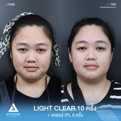 รีวิวรักษาสิว