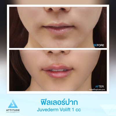 รีวิวฉีดฟิลเลอร์ปาก