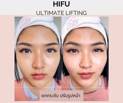 ลดแก้ม กำจัดเหนียง ยกกระชับหน้า แก้ปัญหาหย่อนคล้อย ไม่จำกัดช็อต