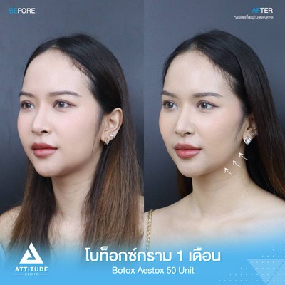 รีวิวฉีดโบท็อกซ์กราม
