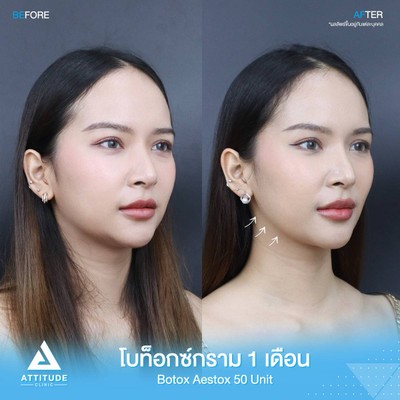 รีวิวฉีดโบท็อกซ์กราม