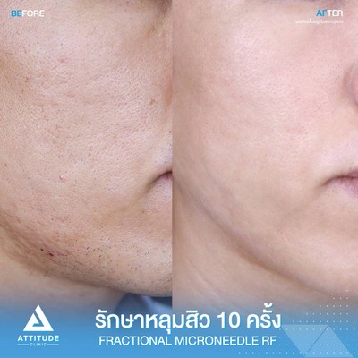รีวิวรักษาหลุมสิว
