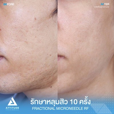 รีวิวรักษาหลุมสิว