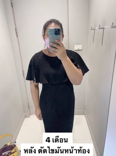 ตัดไขมันหน้าท้อง