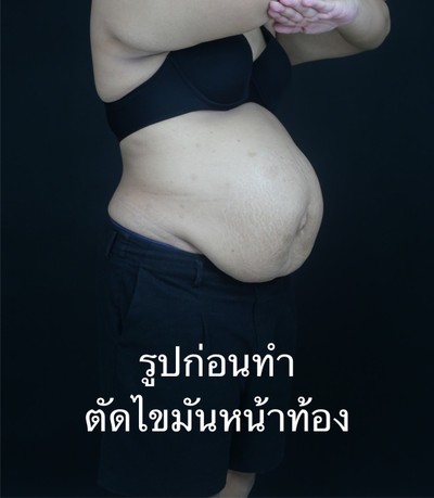 ตัดไขมันหน้าท้อง