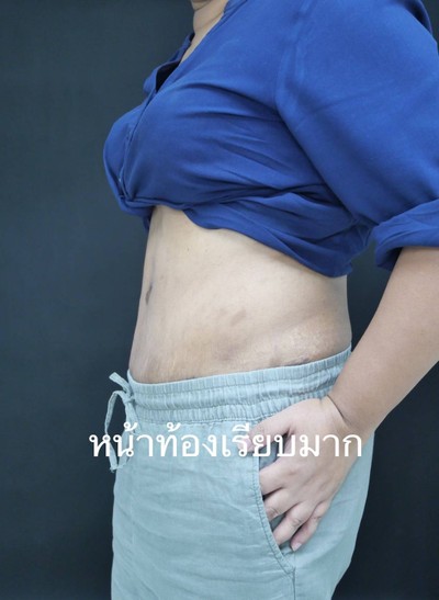 ตัดไขมันหน้าท้อง