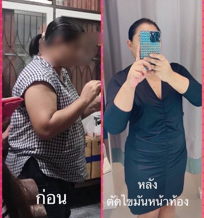 ตัดไขมันหน้าท้อง