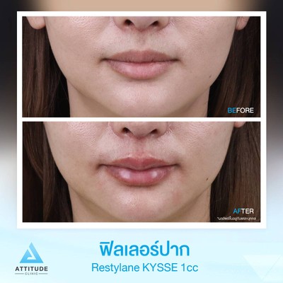 รีวิวฉีดฟิลเลอร์ปาก