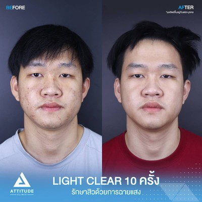 รีวิวรักษาสิว