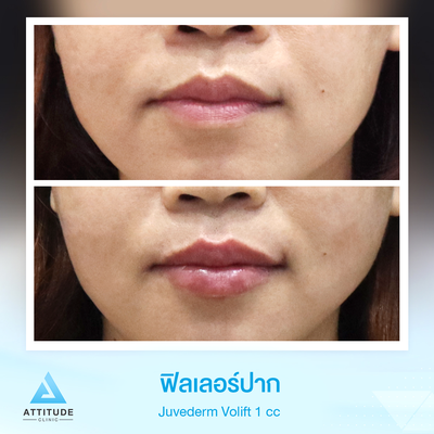 รีวิวฉีดฟิลเลอร์ปาก