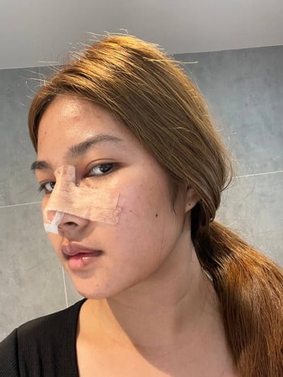 ศัลยกรรมจมูก