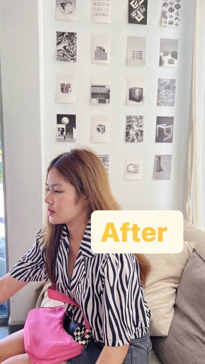 ศัลยกรรมจมูก