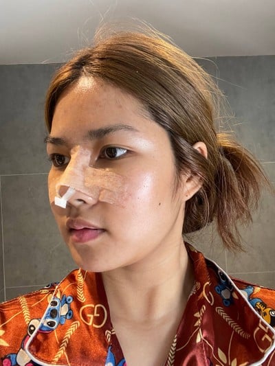 ศัลยกรรมจมูก