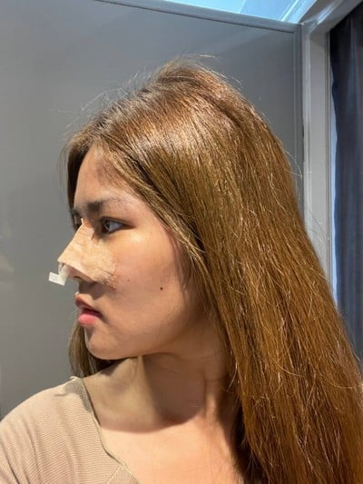 ศัลยกรรมจมูก