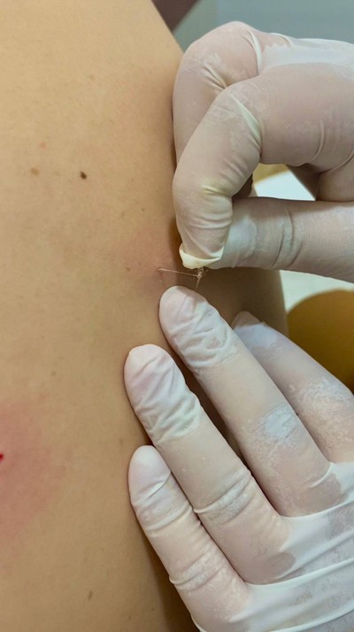 บ่งต้อด้วยหนามหวาย