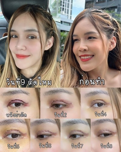 ตาสองชั้นและชั้นตาที่หวานขึ้น