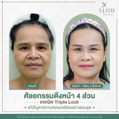 ดึงหน้า