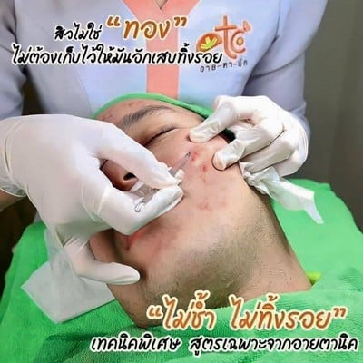 อายตานิค By คุณจันทร์หอม (eitanic By Janhom) ขัดหน้า นวดหน้า กดสิว รักษาสิวผลัดเซลล์ผิวหน้า ฝ้า กระ จุดด่างดำ รักษาผิวหน้าและผิวกาย ครบวงจร สาขาบางชุมโถ หมู่บ้านแก้วกะรัต สุราษฎร์ธานี บางชุมโถ