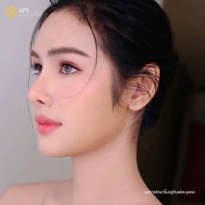 APi Clinic เสริมจมูกเทคนิคเกาหลี by หมอต้น AF