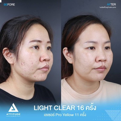 รีวิวรักษาสิว