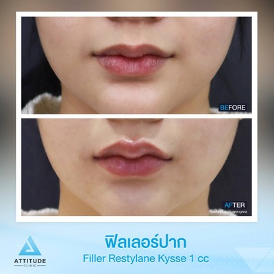 รีวิวฉีดฟิลเลอร์ปาก