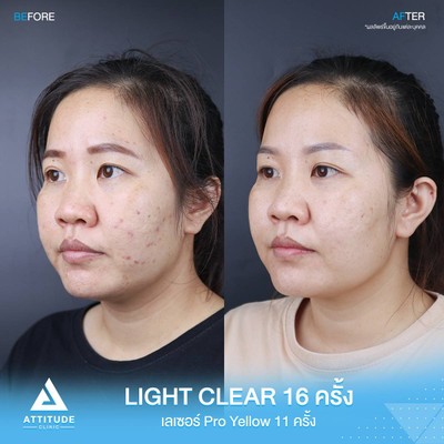 รีวิวรักษาสิว