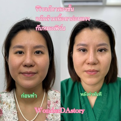 แก้ตาสองชั้น