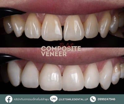 คลินิกทันตกรรมเล็ทสไมล์ลำพูน Let’s smile dental clinic lamphun  -