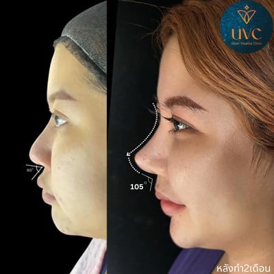 อุบลวิสาขา คลินิก UVC เสริมจมูกโดยหมอมินท์