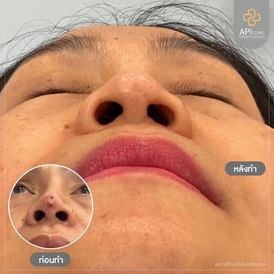 APi Clinic เสริมจมูกเทคนิคเกาหลี by หมอต้น AF