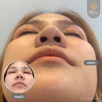 APi Clinic เสริมจมูกเทคนิคเกาหลี by หมอต้น AF