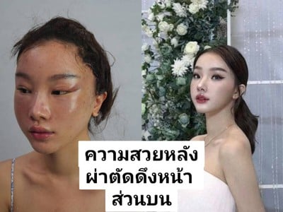 ดึงหน้า MAX Lift