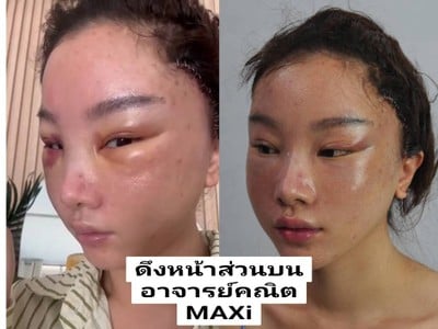 ดึงหน้า MAX Lift