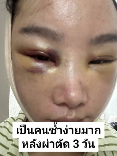 ดึงหน้า MAX Lift