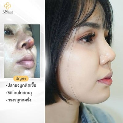 APi Clinic เสริมจมูกเทคนิคเกาหลี by หมอต้น AF
