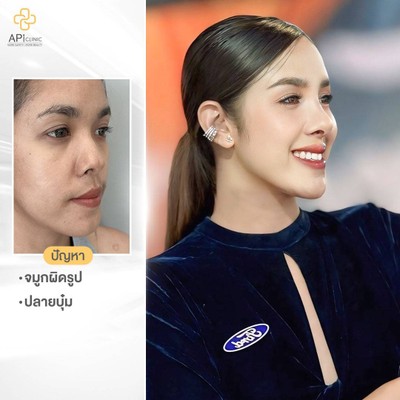 APi Clinic เสริมจมูกเทคนิคเกาหลี by หมอต้น AF