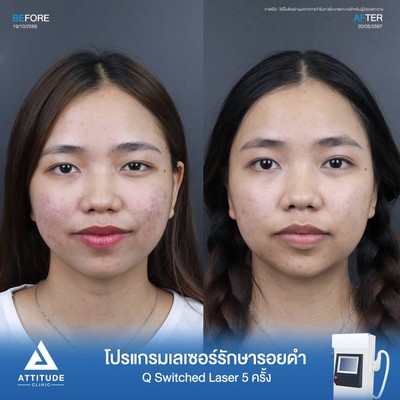รีวิวรักษารอยดำ