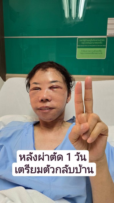 ดึงหน้า MAX Lift