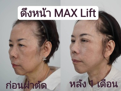 ดึงหน้า MAX Lift