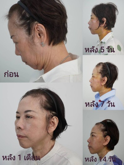 ดึงหน้า MAX Lift