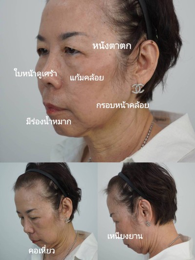 ดึงหน้า MAX Lift