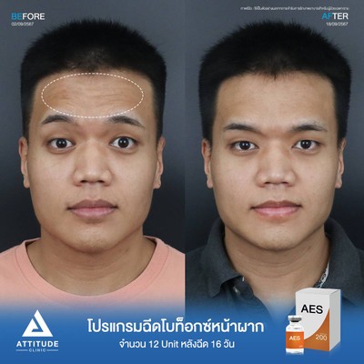รีวิวโปรแกรมฉีดโบท็อกซ์หน้าผาก