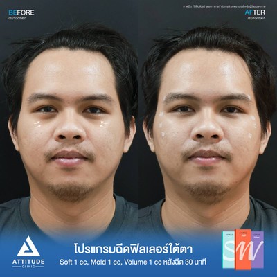 รีวิวโปรแกรมฉีดฟิลเลอร์ใต้ตา