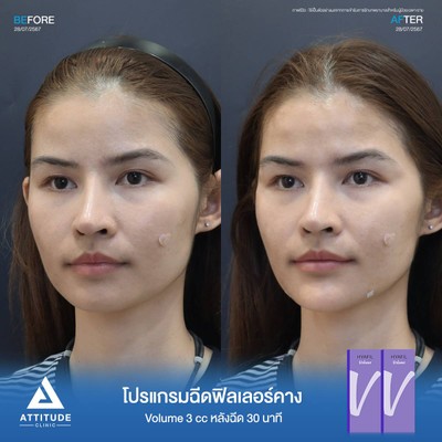 รีวิวโปรแกรมฉีดฟิลเลอร์คาง
