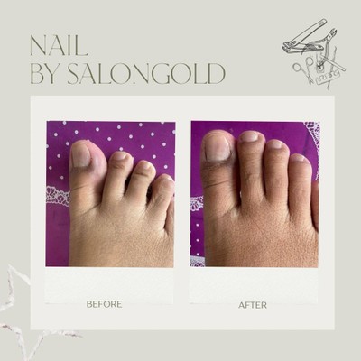 เล็บขบ #ร้านตัดเล็บขบ #ตัดเล็บขบ #ตัดเล็บขบบางนา #ตัดเล็บขบลาซาล #ตัดเล็บขบกรุงเ