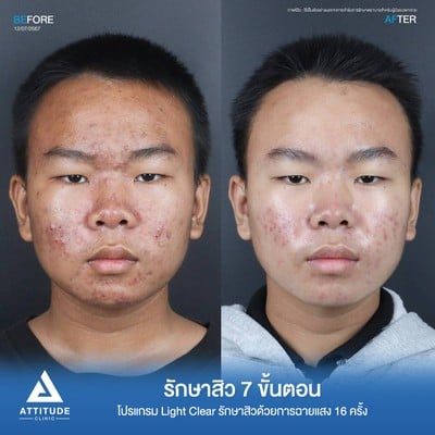 รักษาสิว