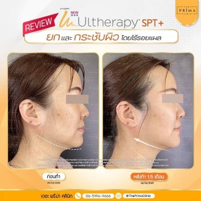 หลังทำอัลเทอร่ากับหมอช้อป 1 เดือนครึ่ง