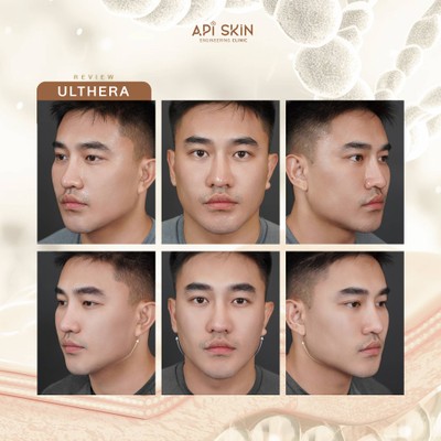APi Clinic Surgery & Wellness เสริมจมูกเทคนิคเกาหลี by หมอต้น AF