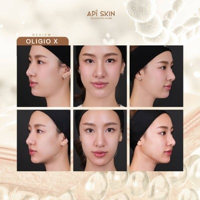 APi Clinic Surgery & Wellness เสริมจมูกเทคนิคเกาหลี by หมอต้น AF